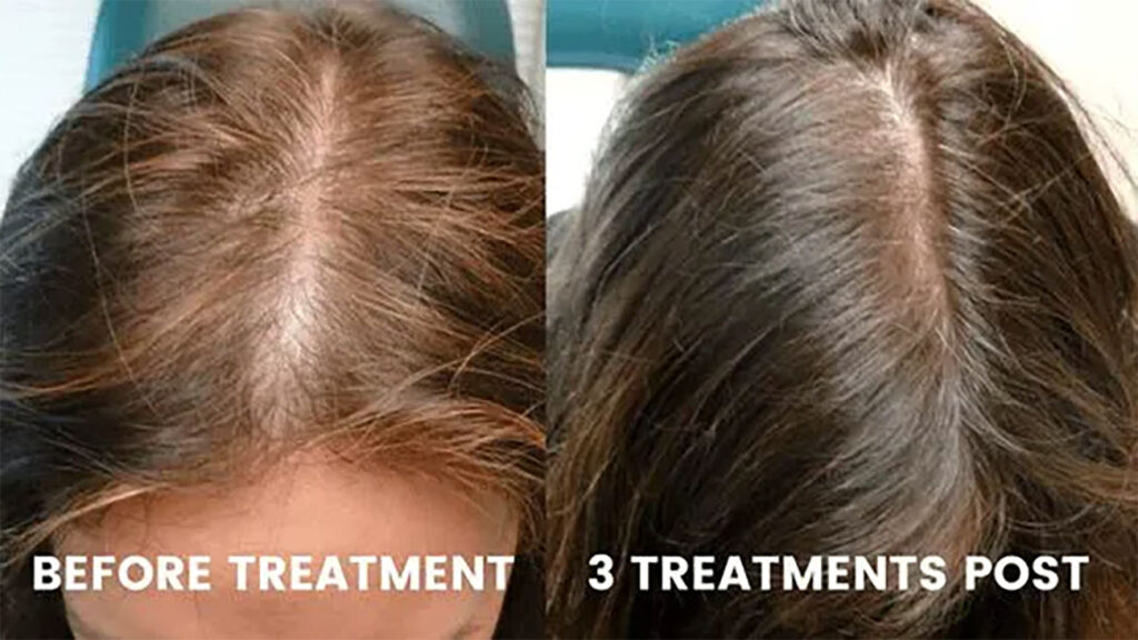 Hairloss-Treatments